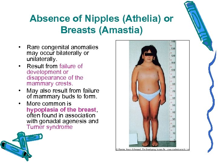 Absence of Nipples (Athelia) or Breasts (Amastia) • Rare congenital anomalies may occur bilaterally