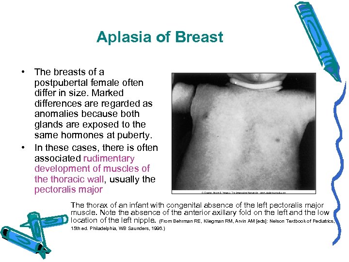 Aplasia of Breast • The breasts of a postpubertal female often differ in size.