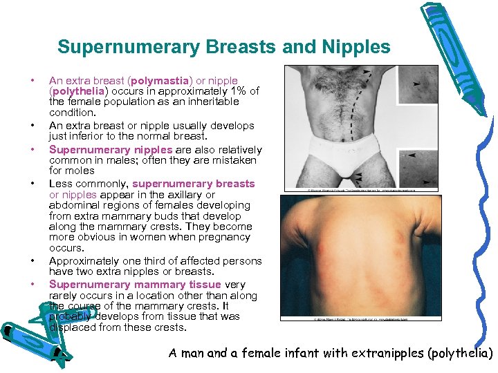 Supernumerary Breasts and Nipples • • • An extra breast (polymastia) or nipple (polythelia)