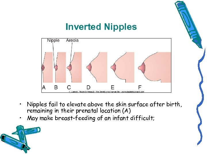 Inverted Nipples • Nipples fail to elevate above the skin surface after birth, remaining