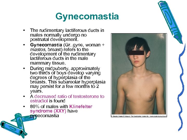 Gynecomastia • • • The rudimentary lactiferous ducts in males normally undergo no postnatal