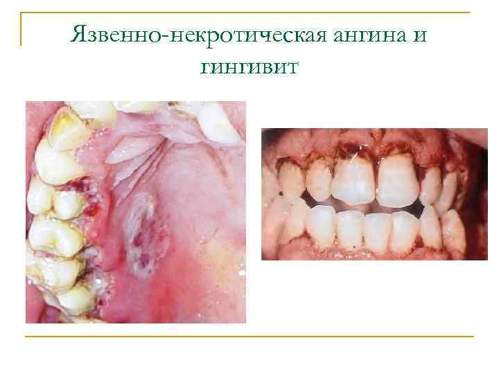 Язвенно-некротическая ангина и гингивит 