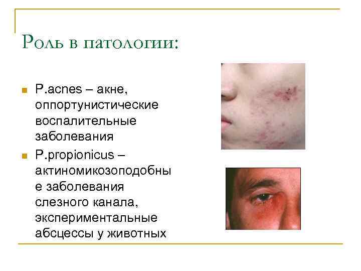 Роль в патологии: n n P. acnes – акне, оппортунистические воспалительные заболевания P. propionicus