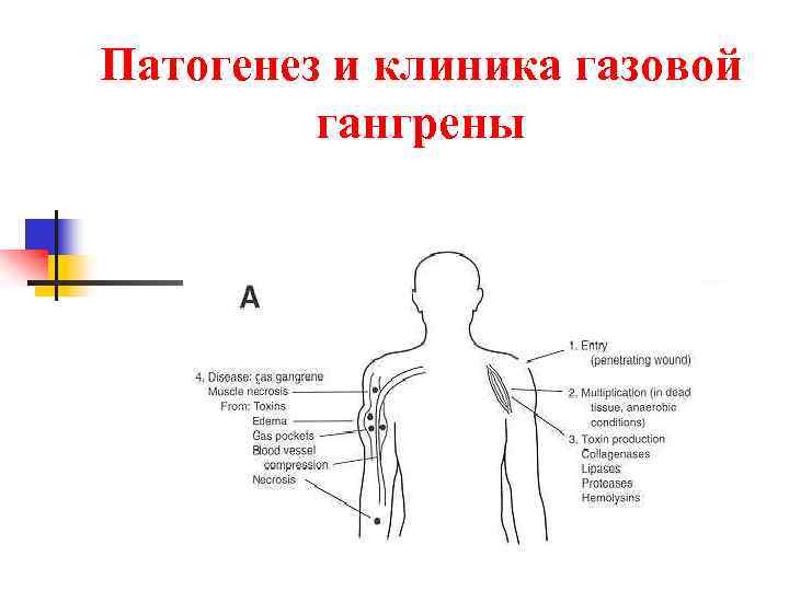 Патогенез и клиника газовой гангрены 