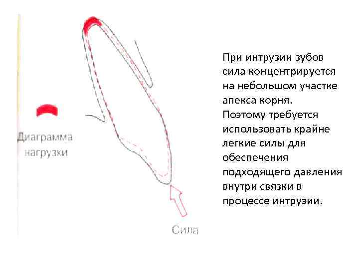 При интрузии зубов сила концентрируется на небольшом участке апекса корня. Поэтому требуется использовать крайне