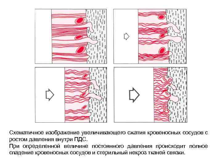 Схематичное изображение увеличивающего сжатия кровеносных сосудов с ростом давления внутри ПДС. При определенной величине