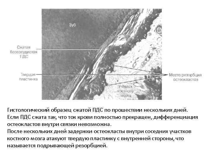 Гистологический образец сжатой ПДС по прошествии нескольких дней. Если ПДС сжата так, что ток
