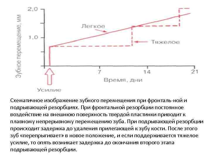 Схематичное изображение зубного перемещения при фронталь ной и подрывающей резорбциях. При фронтальной резорбции постоянное