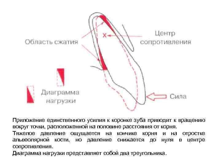 Приложение единственного усилия к коронке зуба приводит к вращению вокруг точки, расположенной на половине