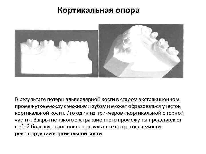 Кортикальная опора В результате потери альвеолярной кости в старом экстракционном промежутке между смежными зубами