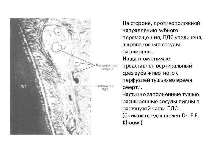 На стороне, противоположной направлению зубного перемеще ния, ПДС увеличена, а кровеносные сосуды расширены. На