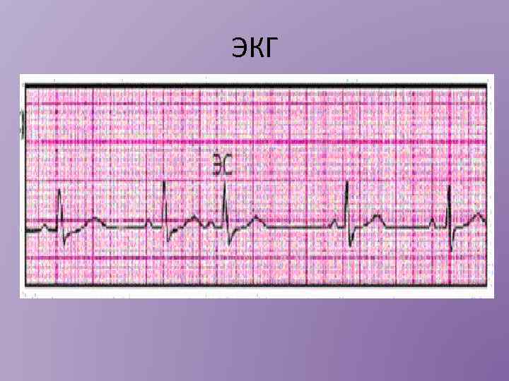 ЭКГ 