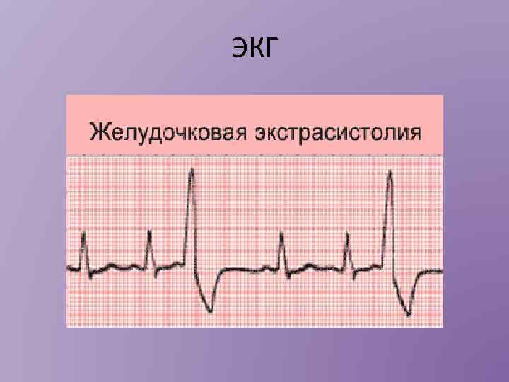 ЭКГ 