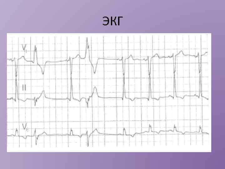 ЭКГ 