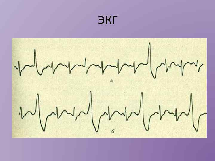 ЭКГ 