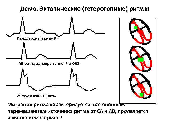 Экг предсердный