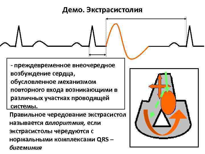 Как ощущаются экстрасистолы. Причины и механизм возникновения экстрасистолы. Повторный вход экстрасистолия. Преждевременное внеочередное возбуждение сердца это. Электрокардиография принцип метода.