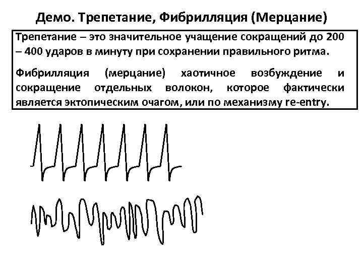 Мерцание трепетание