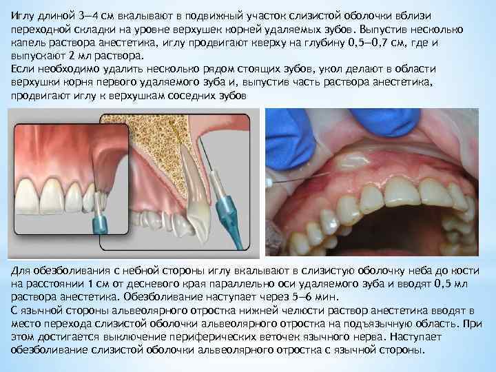 Переходная складка