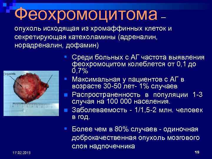 Феохромоцитома – опухоль исходящая из хромаффинных клеток и секретирующая катехоламины (адреналин, норадреналин, дофамин) §