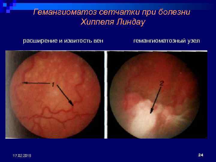 Гемангиоматоз сетчатки при болезни Хиппеля Линдау расширение и извитость вен гемангиоматозный узел 17. 02.