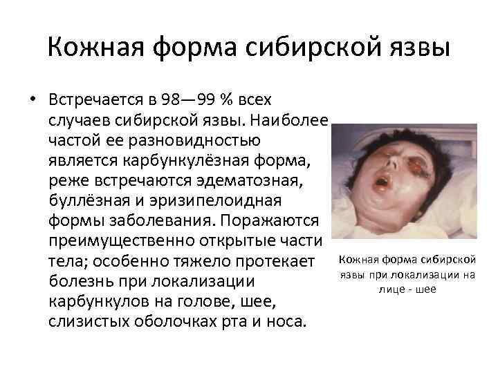 Кожная форма сибирской язвы • Встречается в 98— 99 % всех случаев сибирской язвы.