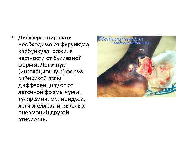  • Дифференцировать необходимо от фурункула, карбункула, рожи, в частности от буллезной формы. Легочную