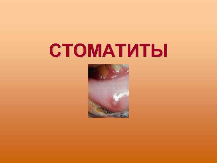 СТОМАТИТЫ 