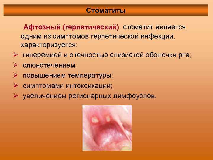 Стоматиты Ø Ø Ø Афтозный (герпетический) стоматит является одним из симптомов герпетической инфекции, характеризуется: