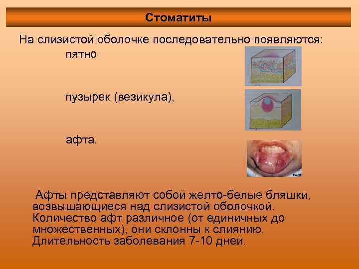 Стоматиты На слизистой оболочке последовательно появляются: пятно пузырек (везикула), афта. Афты представляют собой желто-белые