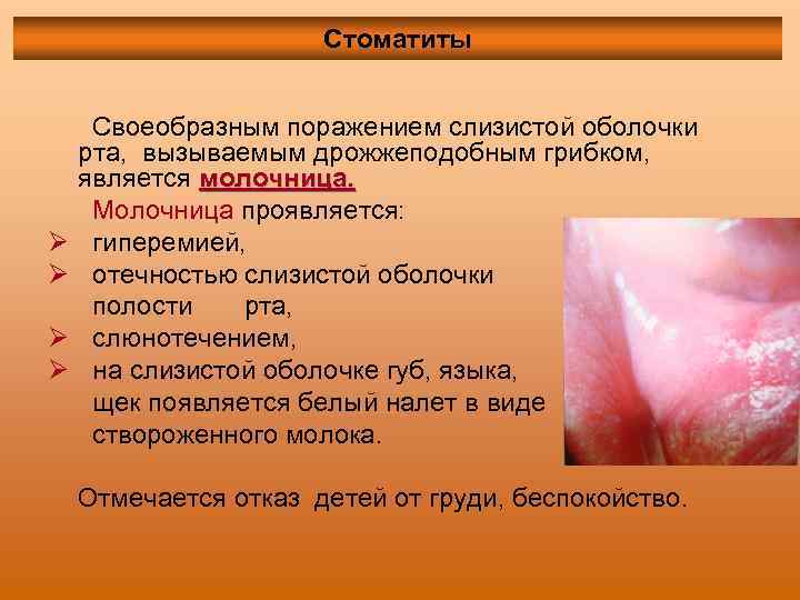 Стоматиты Ø Ø Своеобразным поражением слизистой оболочки рта, вызываемым дрожжеподобным грибком, является молочница. Молочница