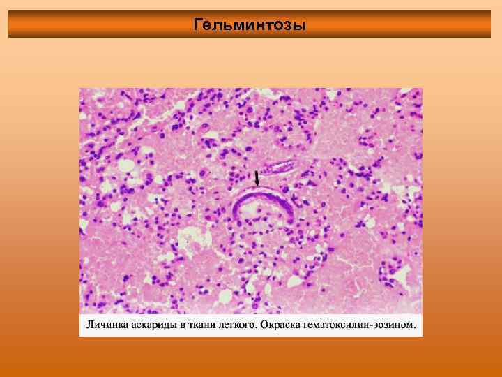 Гельминтозы 