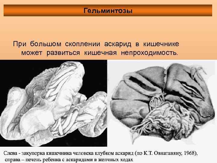 Гельминтозы При большом скоплении аскарид в кишечнике может развиться кишечная непроходимость. 