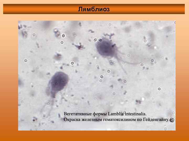 Лямблиоз 