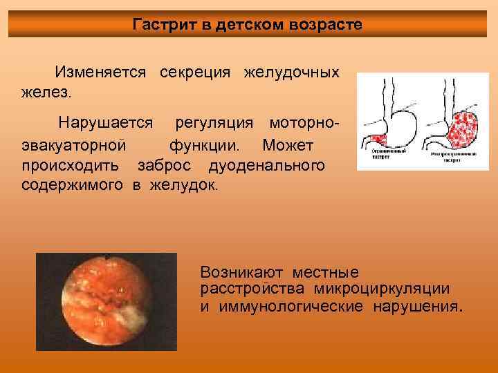 Гастрит в детском возрасте Изменяется секреция желудочных желез. Нарушается регуляция моторноэвакуаторной функции. Может происходить