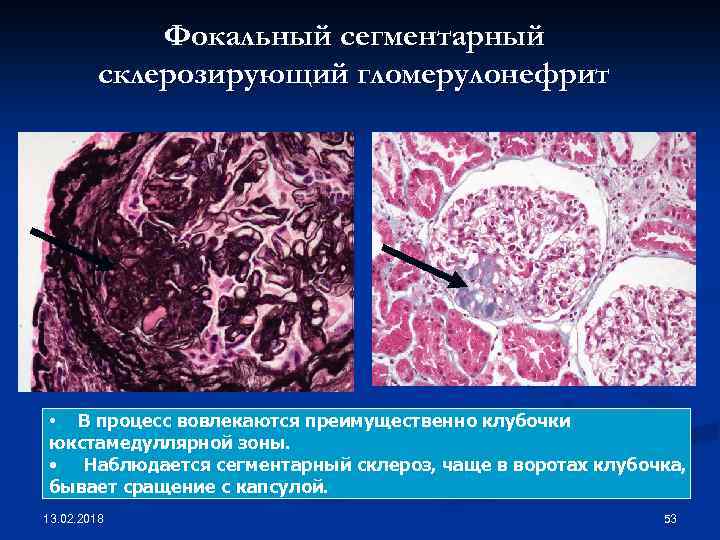 Фокальный сегментарный склерозирующий гломерулонефрит • В процесс вовлекаются преимущественно клубочки юкстамедуллярной зоны. • Наблюдается