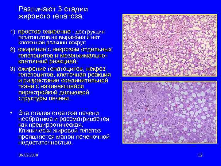 Различают 3 стадии жирового гепатоза: 1) простое ожирение деструкция гепатоцитов не выражена и нет