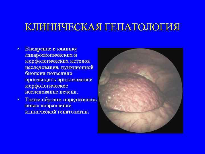 КЛИНИЧЕСКАЯ ГЕПАТОЛОГИЯ • Внедрение в клинику лапароскопических и морфологических методов исследования, пункционной биопсии позволило