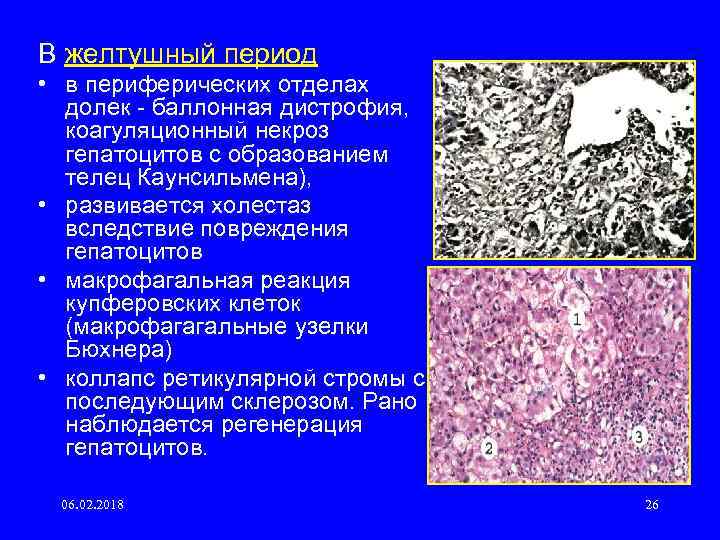 В желтушный период • в периферических отделах долек баллонная дистрофия, коагуляционный некроз гепатоцитов с