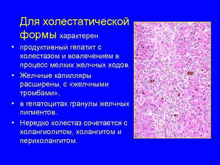 Для холестатической формы характерен • продуктивный гепатит с холестазом и вовлечением в процесс мелких