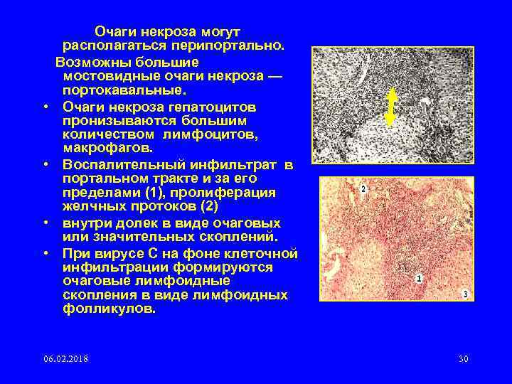  • • Очаги некроза могут располагаться перипортально. Возможны большие мостовидные очаги некроза —