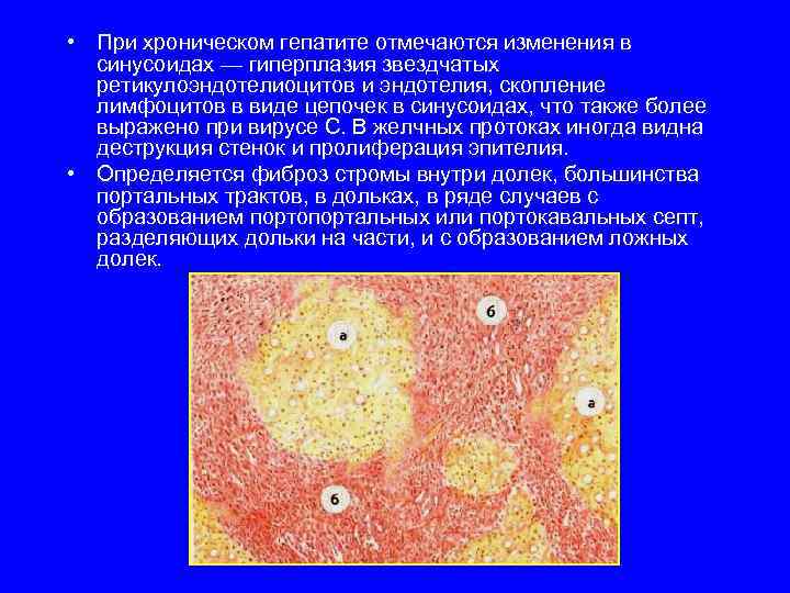  • При хроническом гепатите отмечаются изменения в синусоидах — гиперплазия звездчатых ретикулоэндотелиоцитов и