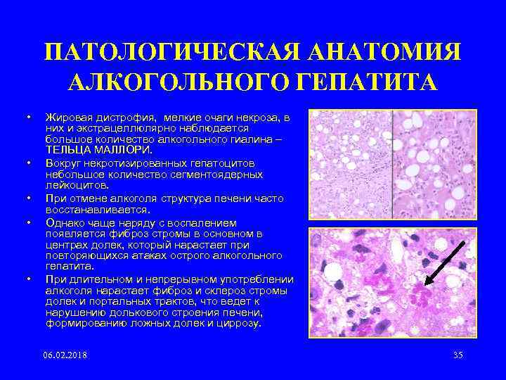 ПАТОЛОГИЧЕСКАЯ АНАТОМИЯ АЛКОГОЛЬНОГО ГЕПАТИТА • • • Жировая дистрофия, мелкие очаги некроза, в них