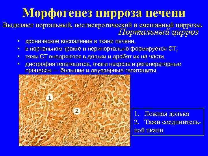 Морфогенез цирроза печени Выделяют портальный, постнекротический и смешанный циррозы. Портальный цирроз • • хроническое