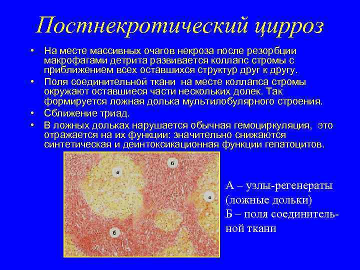 Постнекротический цирроз • На месте массивных очагов некроза после резорбции макрофагами детрита развивается коллапс