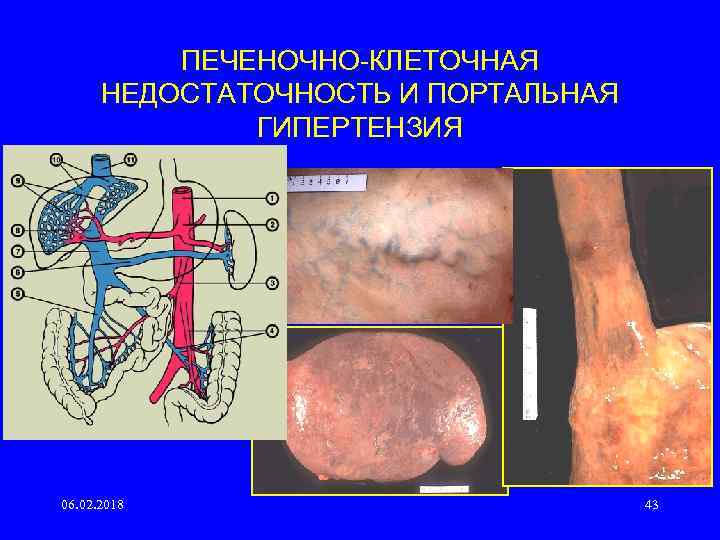 ПЕЧЕНОЧНО КЛЕТОЧНАЯ НЕДОСТАТОЧНОСТЬ И ПОРТАЛЬНАЯ ГИПЕРТЕНЗИЯ 06. 02. 2018 43 