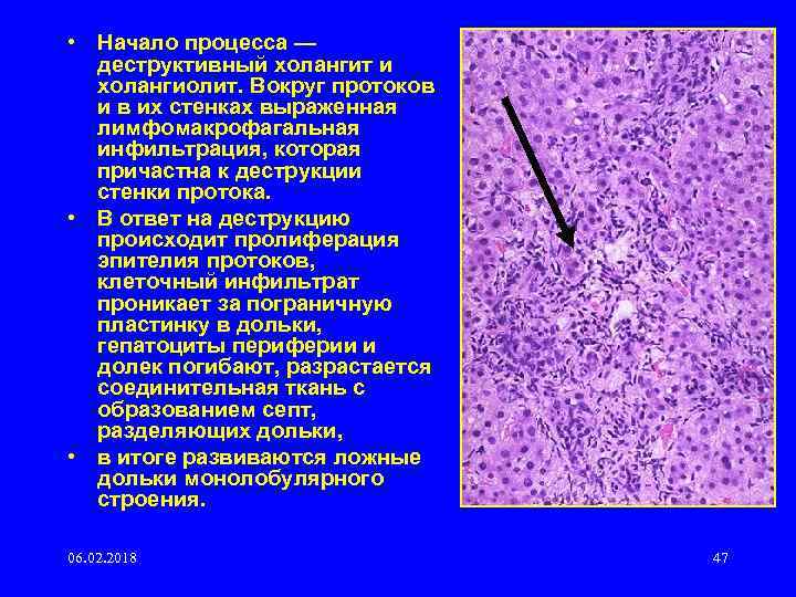  • Начало процесса — деструктивный холангит и холангиолит. Вокруг протоков и в их