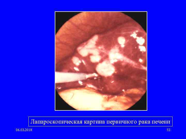 Лапароскопическая картина первичного рака печени 06. 02. 2018 52 