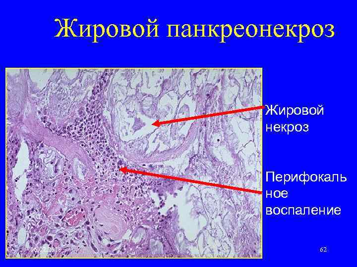 Жировой панкреонекроз Жировой некроз Перифокаль ное воспаление 06. 02. 2018 62 