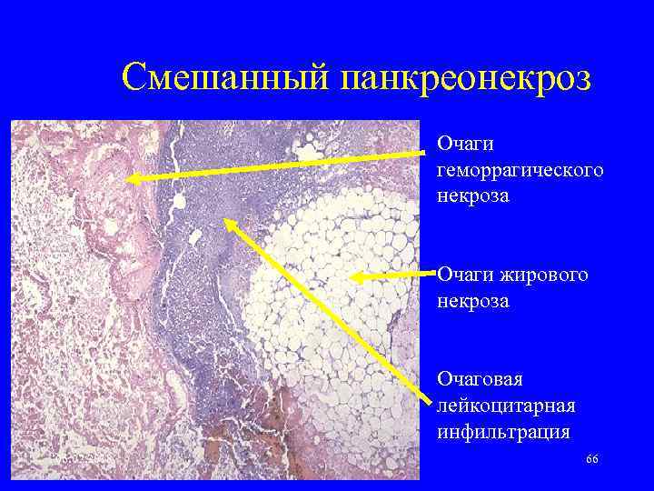 Смешанный панкреонекроз Очаги геморрагического некроза Очаги жирового некроза Очаговая лейкоцитарная инфильтрация 06. 02. 2018